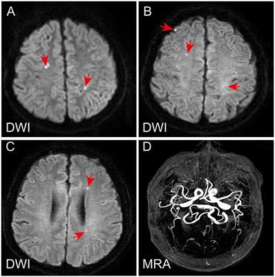 Case report: COVID-19-associated refractory thrombotic thrombocytopenic purpura complicated with Guillain-Barré syndrome